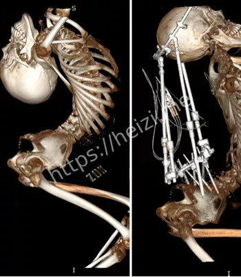 直立站起重获新生