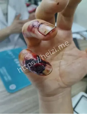 手指被咬伤案件