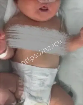洛阳28岁产妇羊水栓塞昏迷